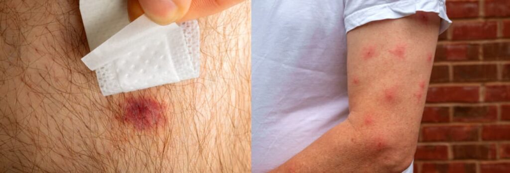 Spider Bite vs Mosquito Bite: Key Differences